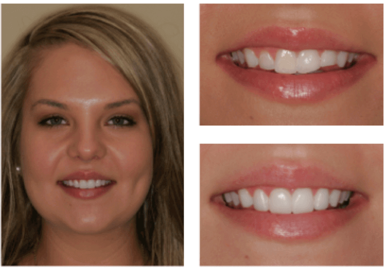 Beautiful smile transformation result